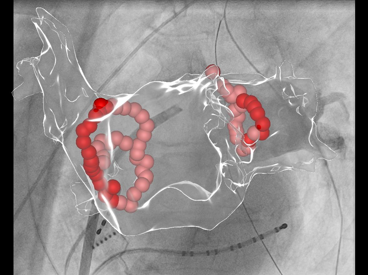 Grafische Darstellung eines medizinischen Eingriffs mit überlagerten 3D-Modellem von Leitern und stachelartigen Objekten, möglicherweise in einem chirurgischen oder endoskopischen Setting.