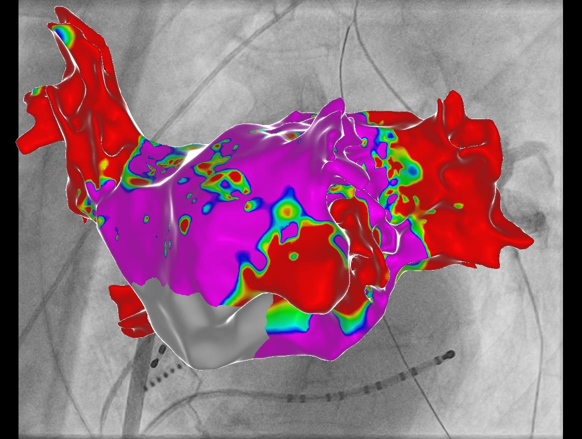 Ein dreidimensionales medizinisches Modell des Herzens mit farbiger Oberflächenanzeige auf einem Röntgenbild. 3D Navigation einer Vorhofflimmerablation
