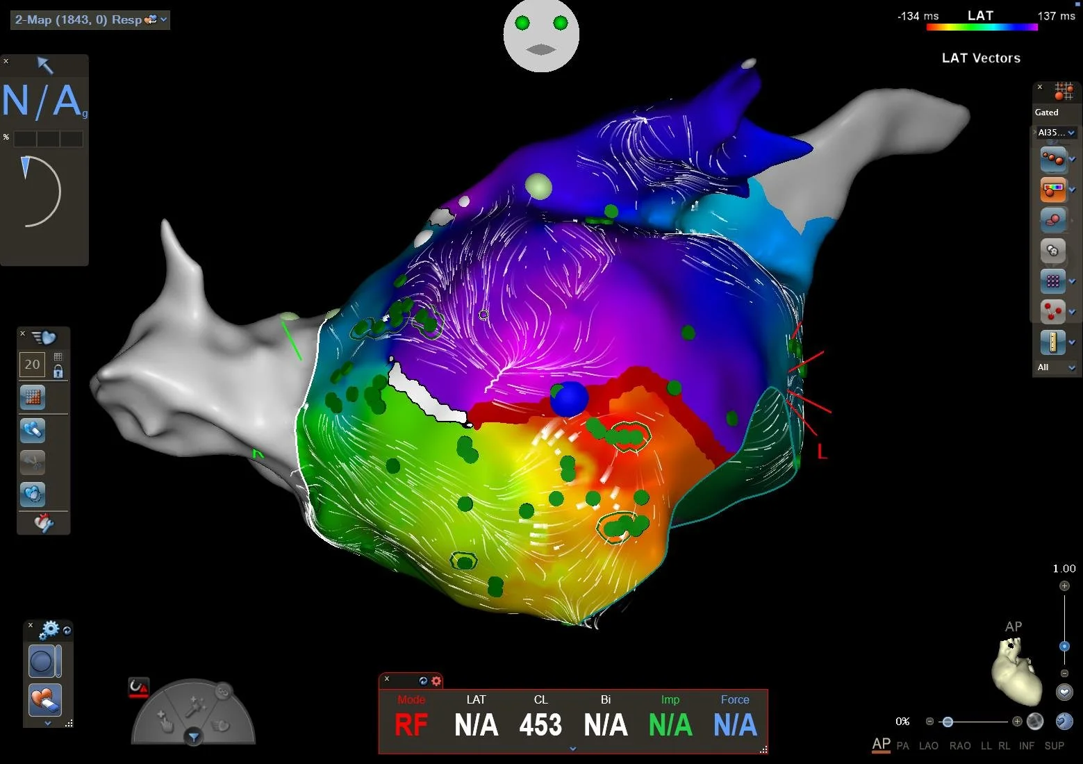 3D Navigation einer Vorhofflimmerablation, ultrahochauflösend