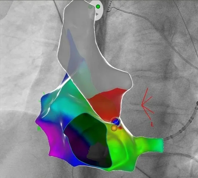 Ein 3D-Modell eines menschlichen Herzklappenersatzes auf einem medizinischen Röntgenbild.