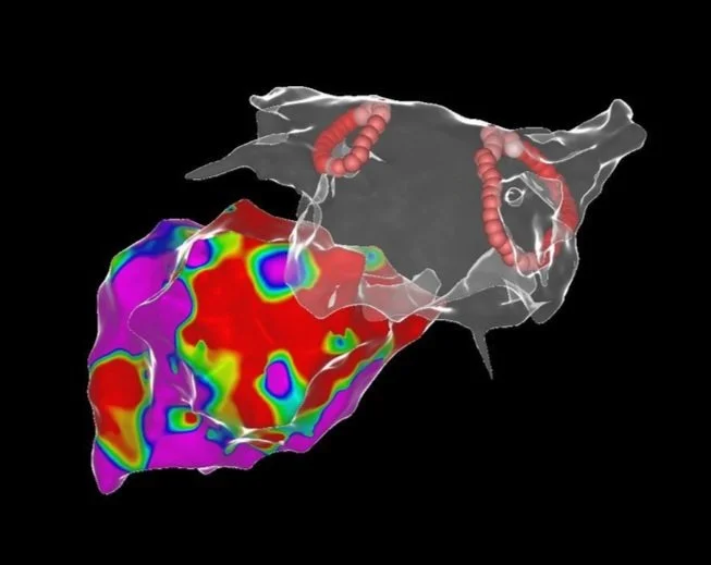 3D Navigation einer Vorhofflimmerablation