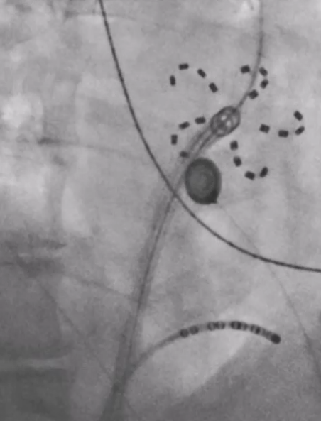 Schwarz-weiß-Scan eines medizinischen Bildes, zeigt eine Zelle oder einen implantierten Gegenstand mit umgebenden Markierungen, Linien und Punkten, vermutlich eine Röntgenaufnahme oder ein ähnliches radiologisches Bild.