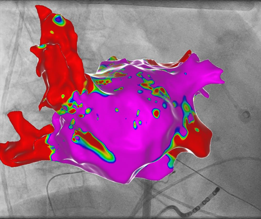Ein medizinisches Bild mit farblich markierten anatomischen Strukturen, vermutlich im Zusammenhang mit einer Operation oder Diagnose.