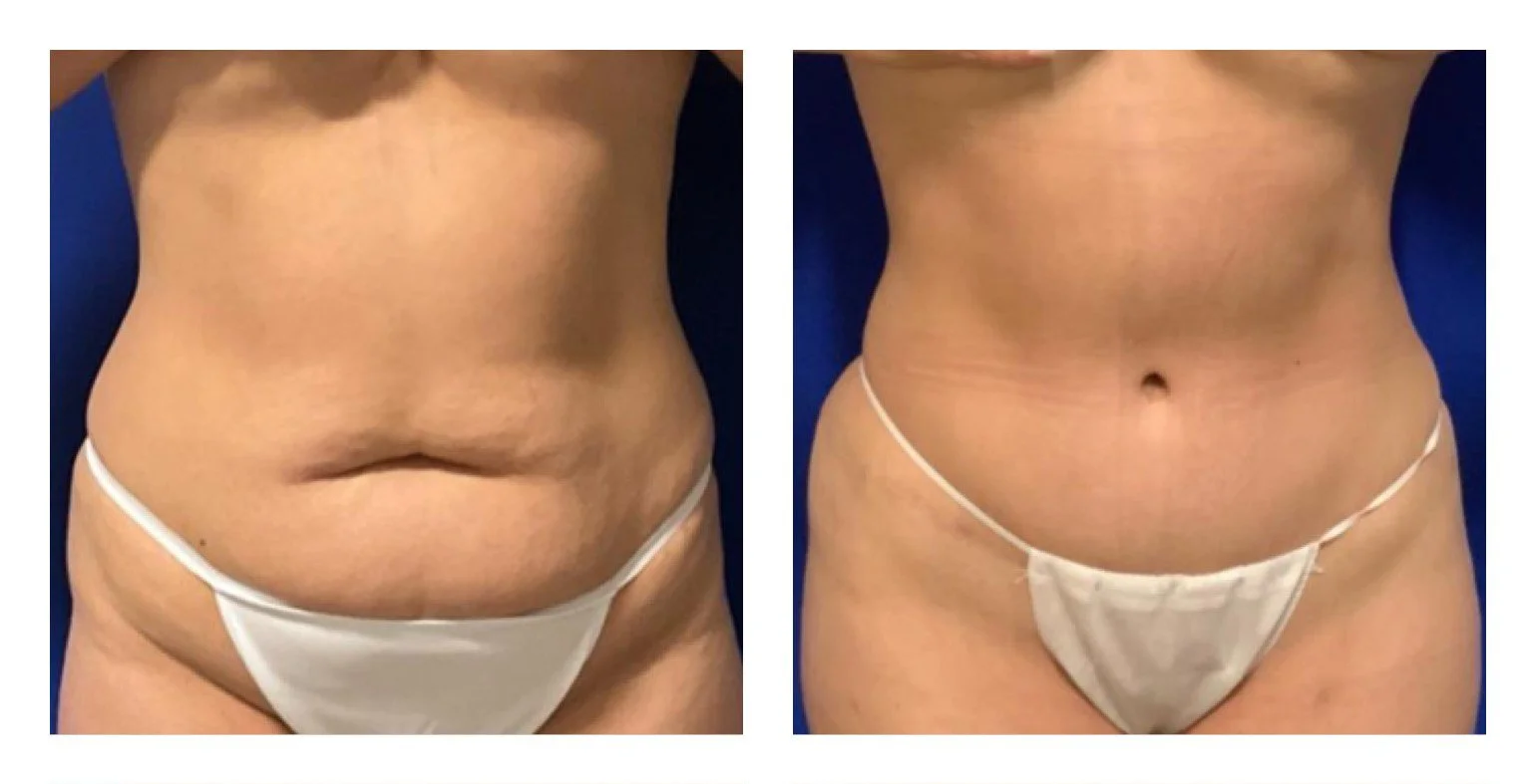 Side-by-side comparison of a woman's abdomen before and after a cosmetic procedure, showing reduced abdominal fat and improved skin tightness.