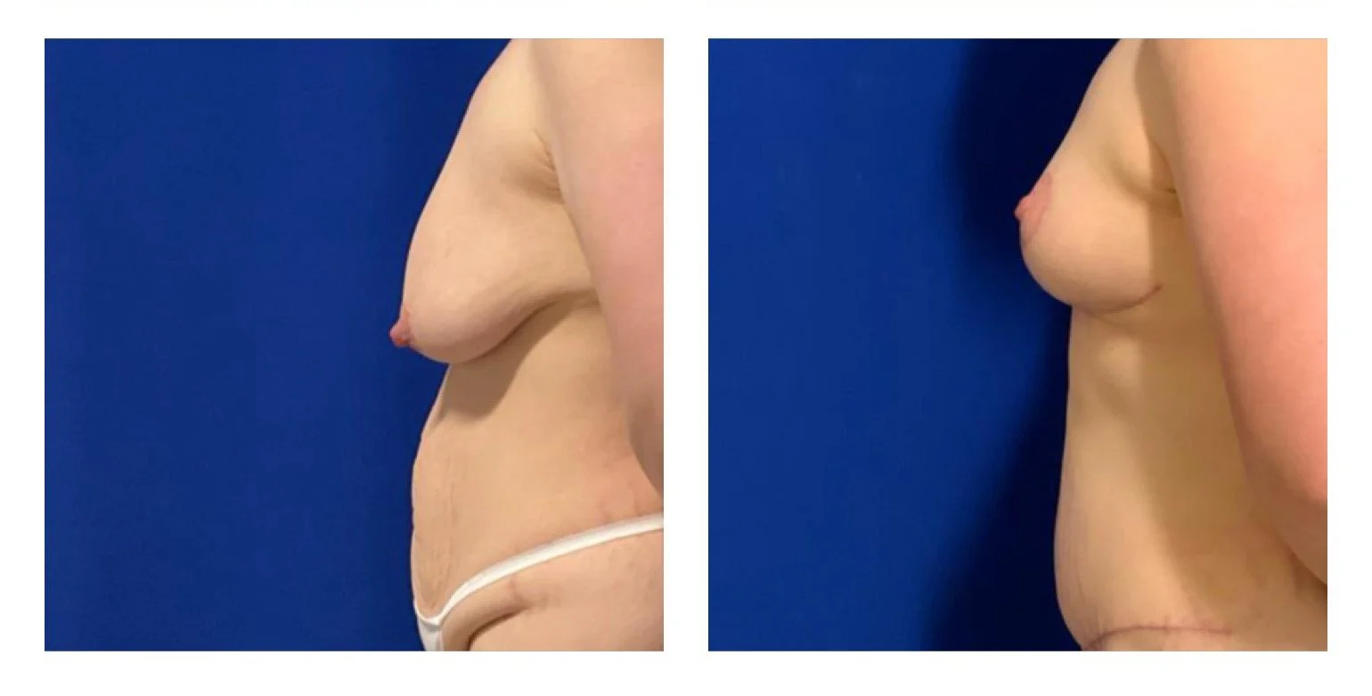 Breast lift 2.jpg