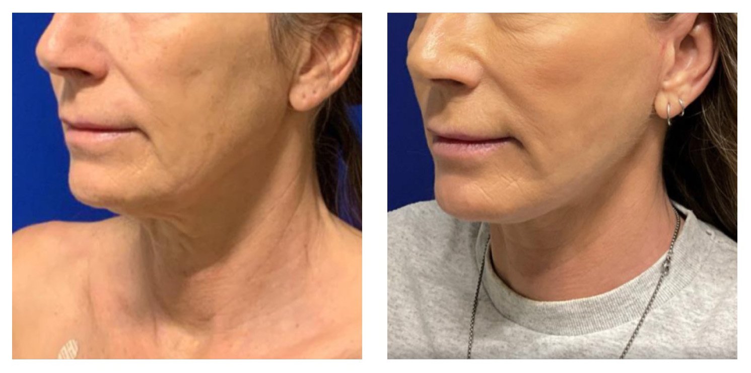 Side-by-side comparison of a woman's face before and after cosmetic treatment, showing reduced wrinkles and improved skin texture.