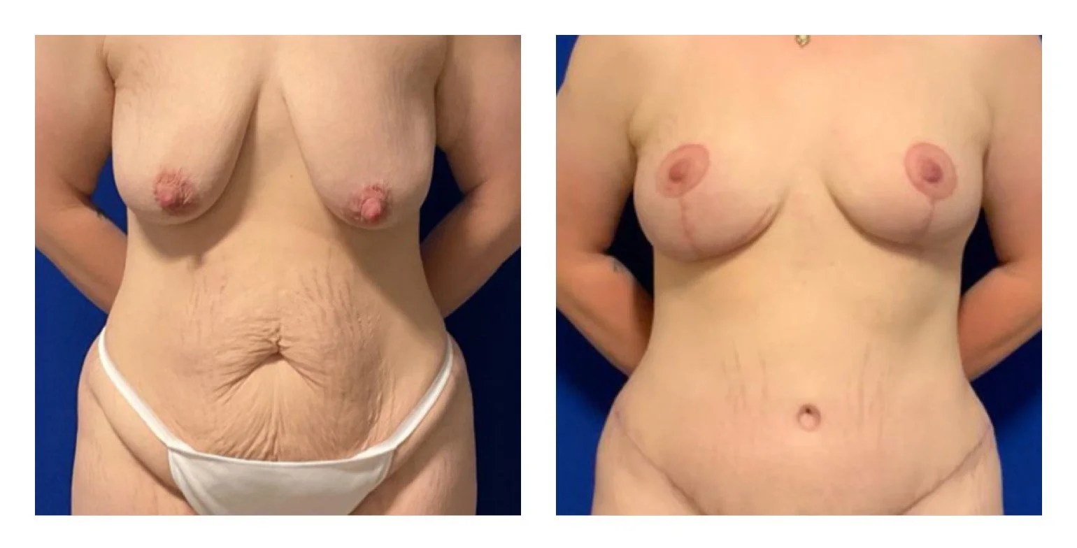 breast lift 1.jpg