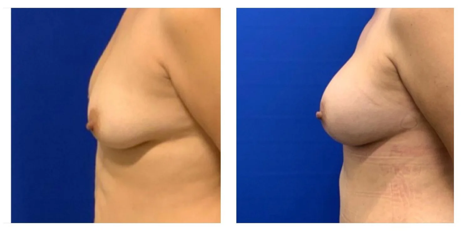 Comparison of a woman's breast before and after surgery, shown from the side against a blue background.