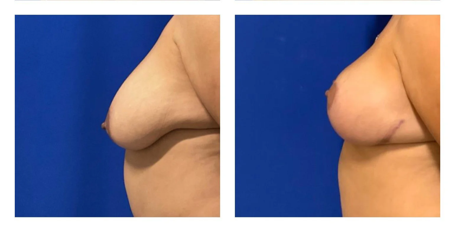 breast lift 8.jpg