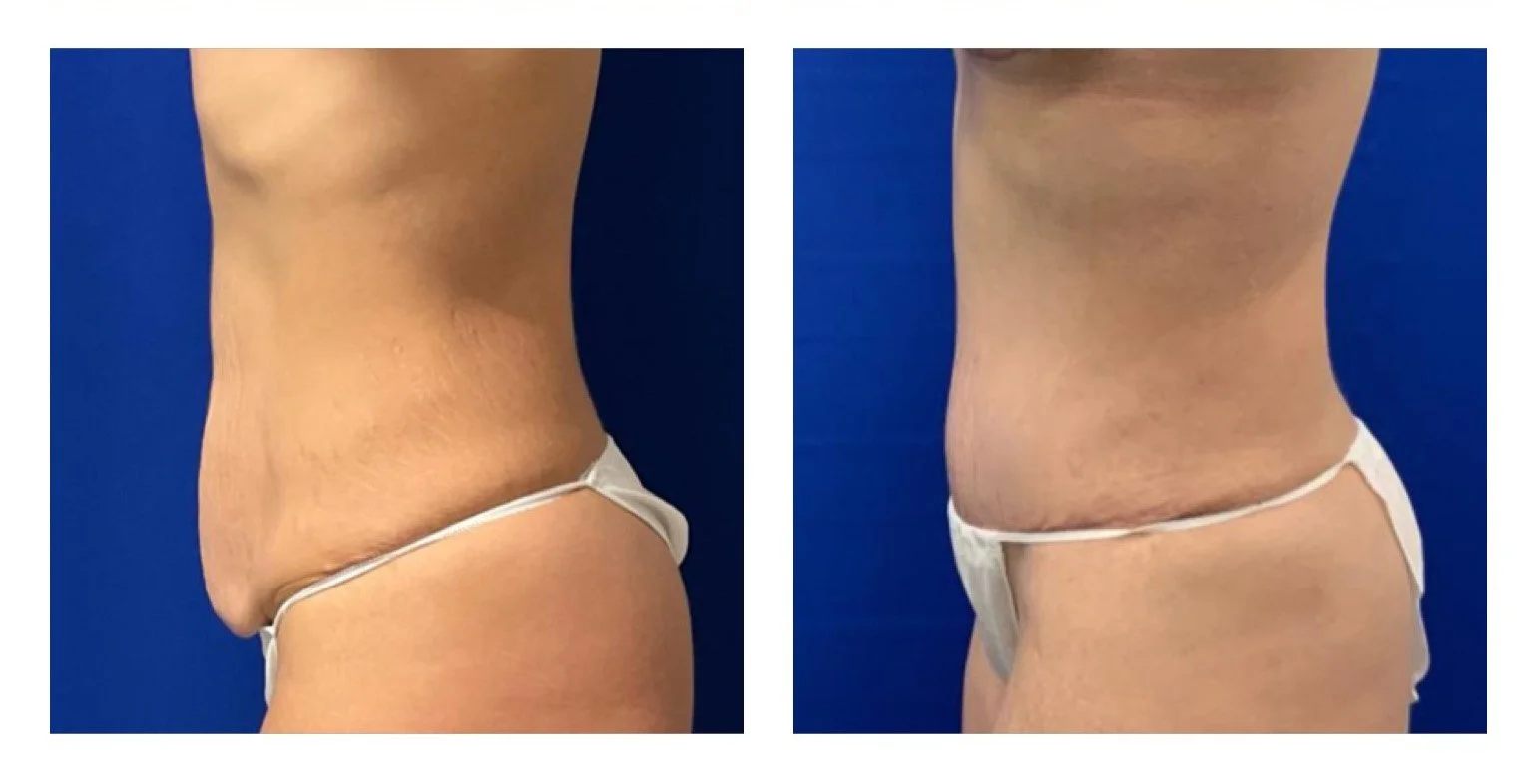 Before and after photos of a woman's abdomen showing skin tightening and fat reduction with a focus on a flatter stomach.
