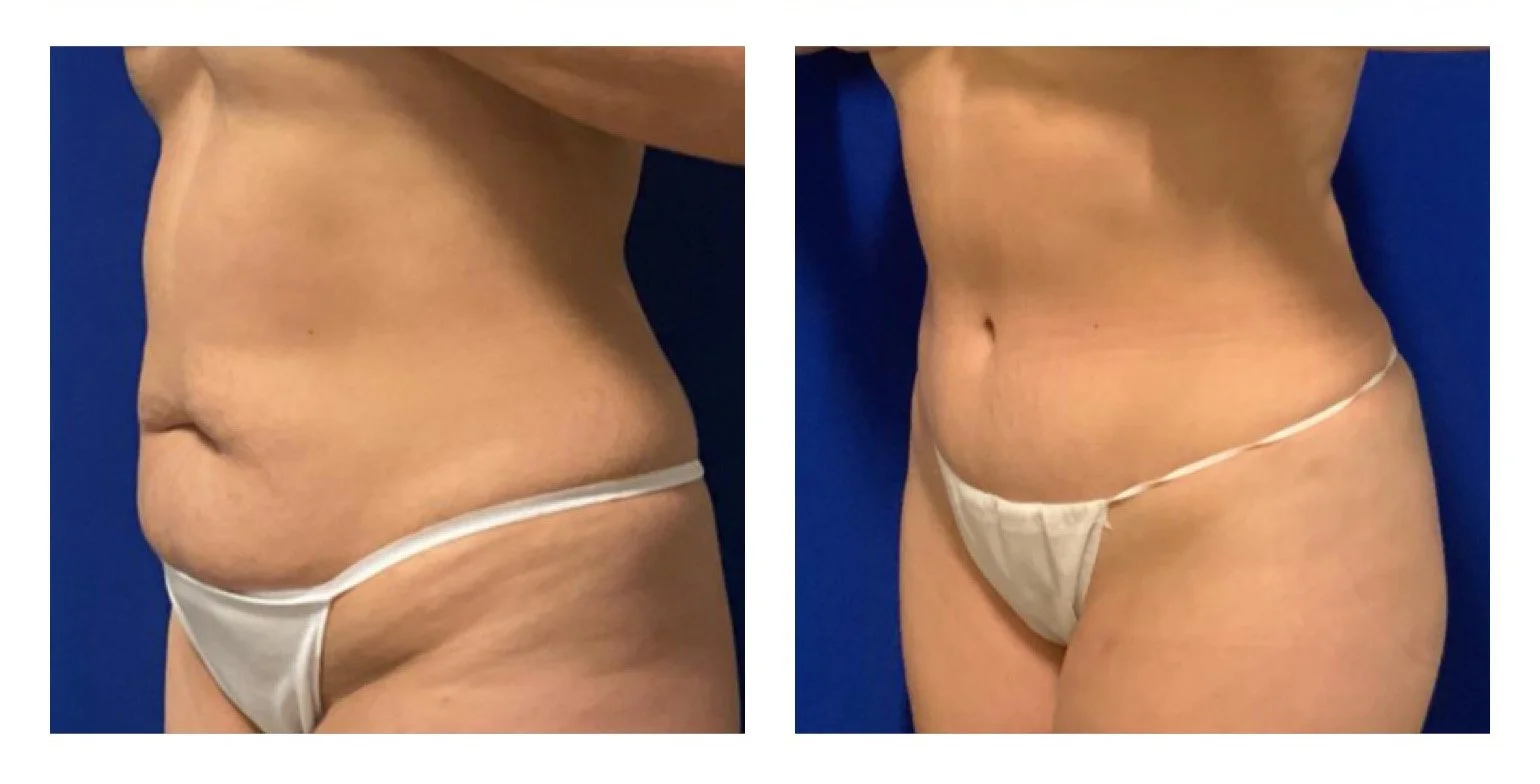 Before and after images showing a woman's abdomen with visible fat reduction and improved contour.