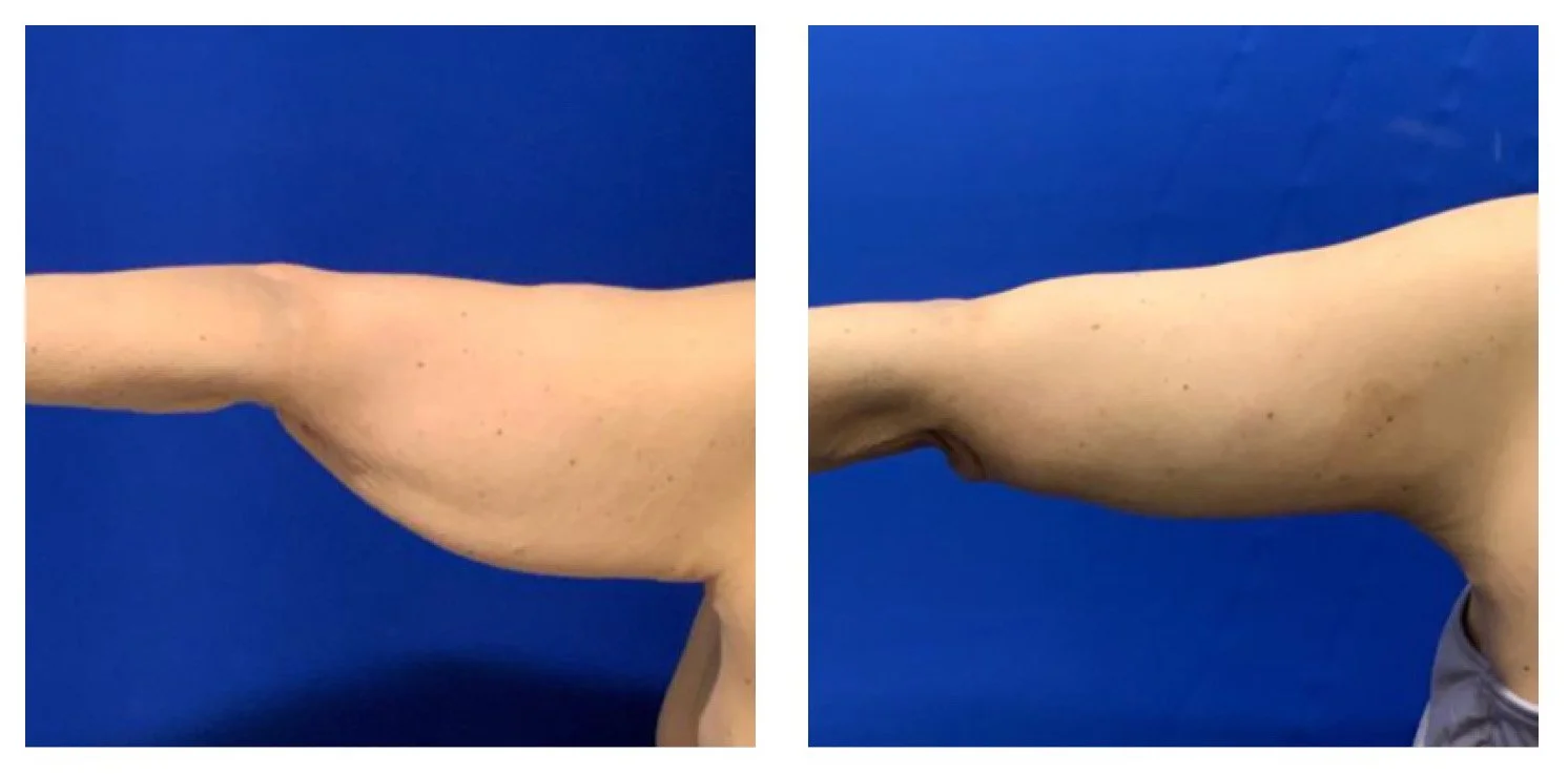 Comparison of a person's arm before and after skin tightening treatment, showing reduced sagging on the right side.