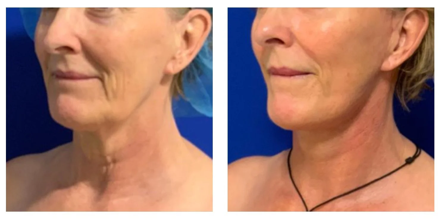 Side-by-side comparison of an older woman's face, showing improvements in skin appearance and texture after a treatment or skincare regimen.