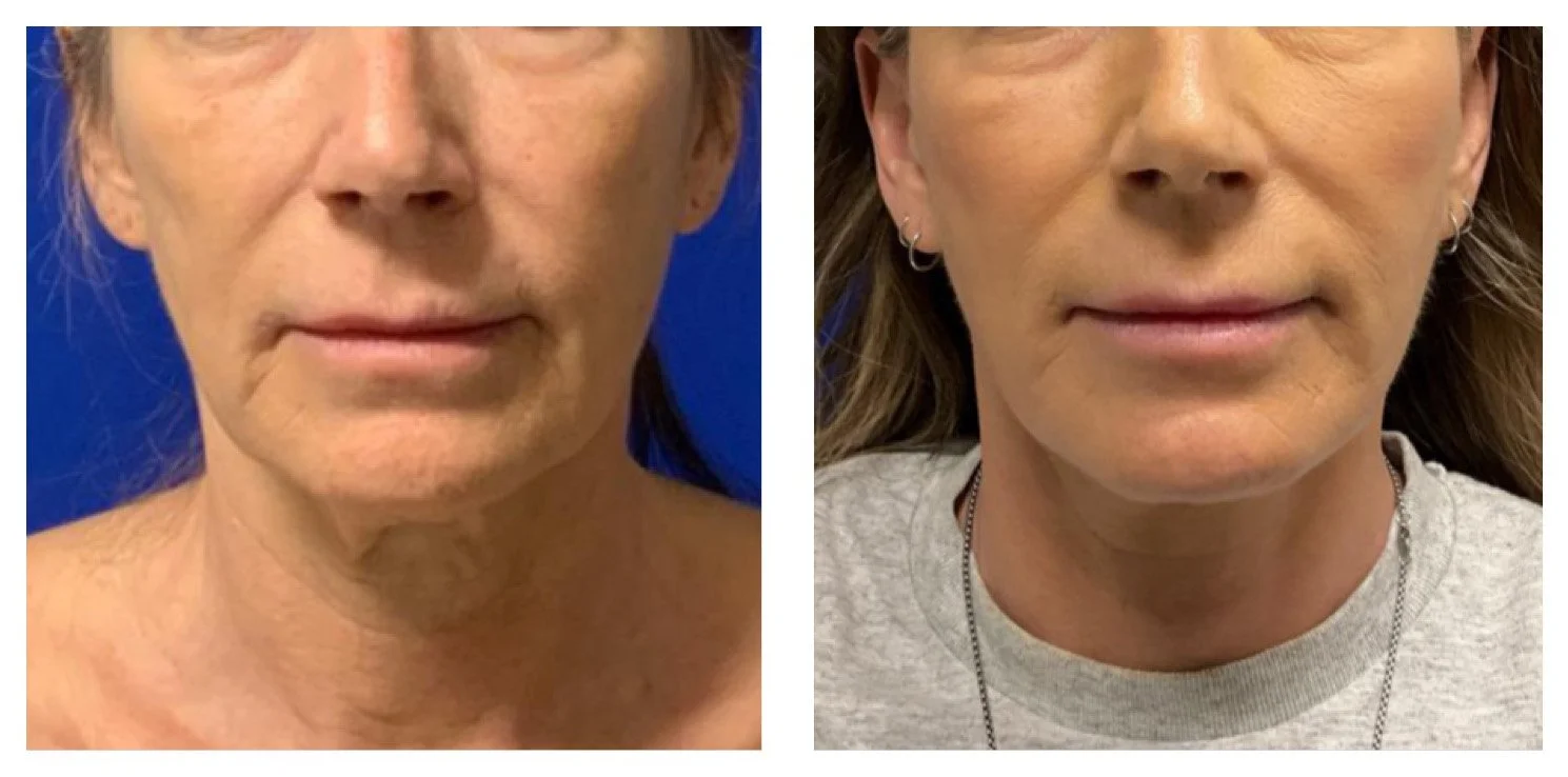 Side-by-side comparison of a woman's face before and after cosmetic treatment, showing facial improvements.