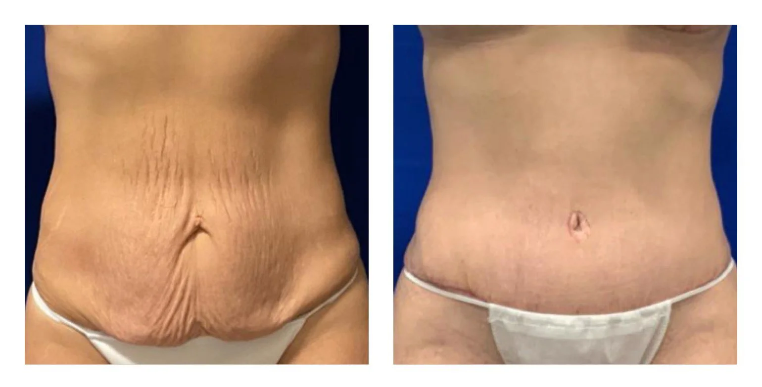 Comparison of a woman's abdominal area showing loose skin and wrinkles on the left, and smooth, tightened skin on the right after a cosmetic procedure or weight loss.