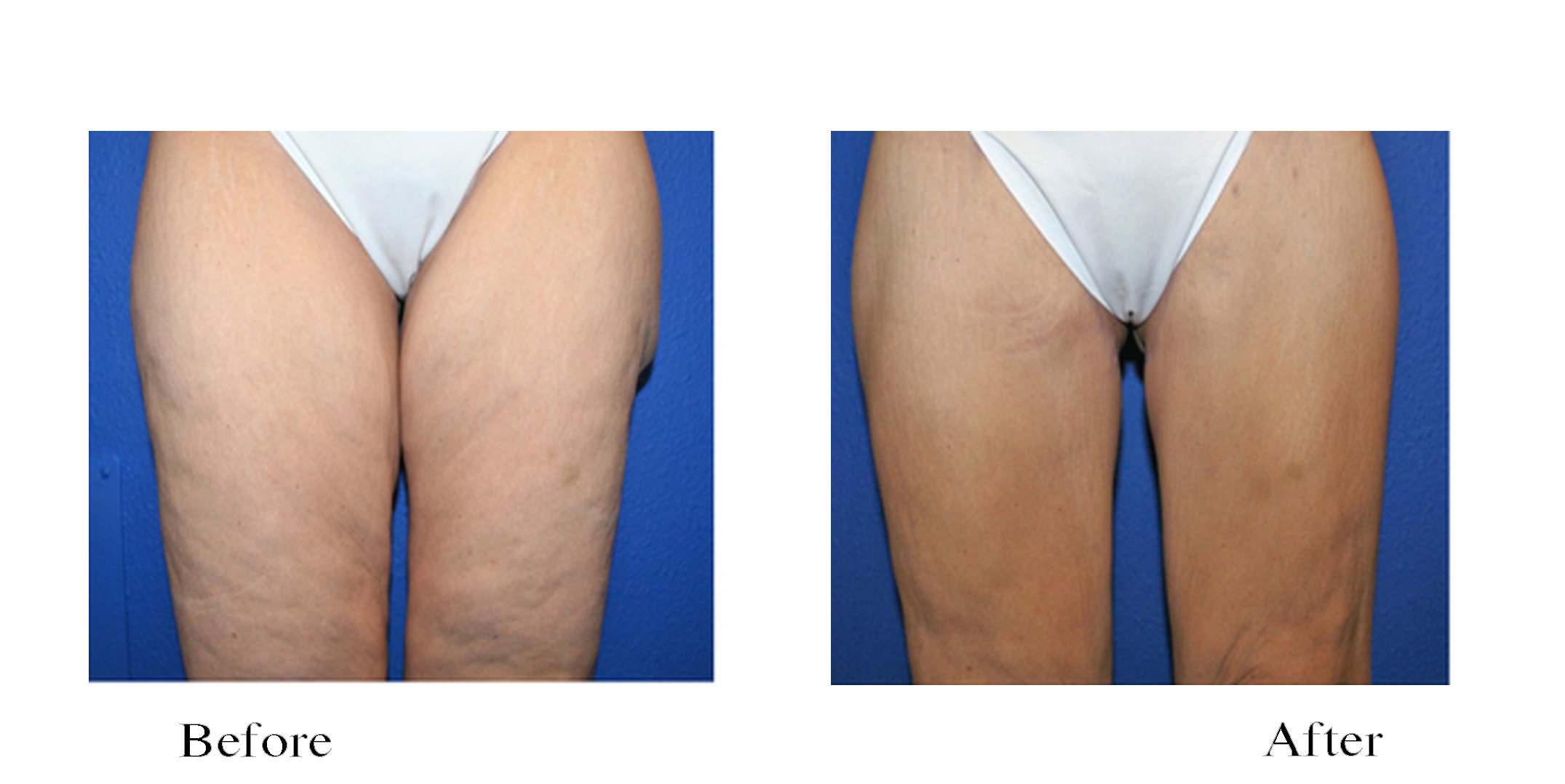 Before and after images showing thigh cellulite reduction.