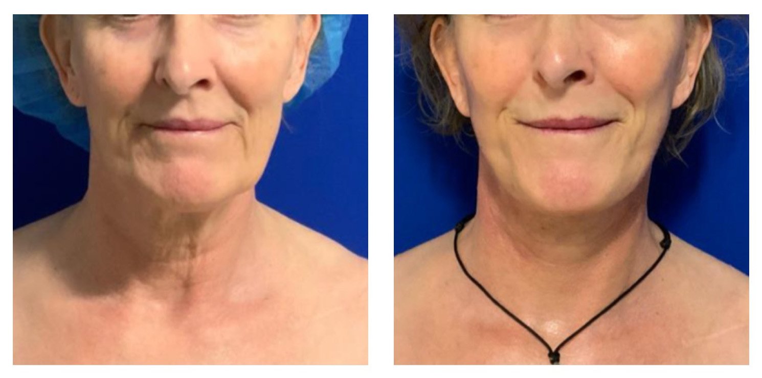 Side-by-side before and after photos of an older woman, showing facial and neck skin improvements, with the woman wearing a hair cap in the first photo and a necklace in the second, set against a blue background.