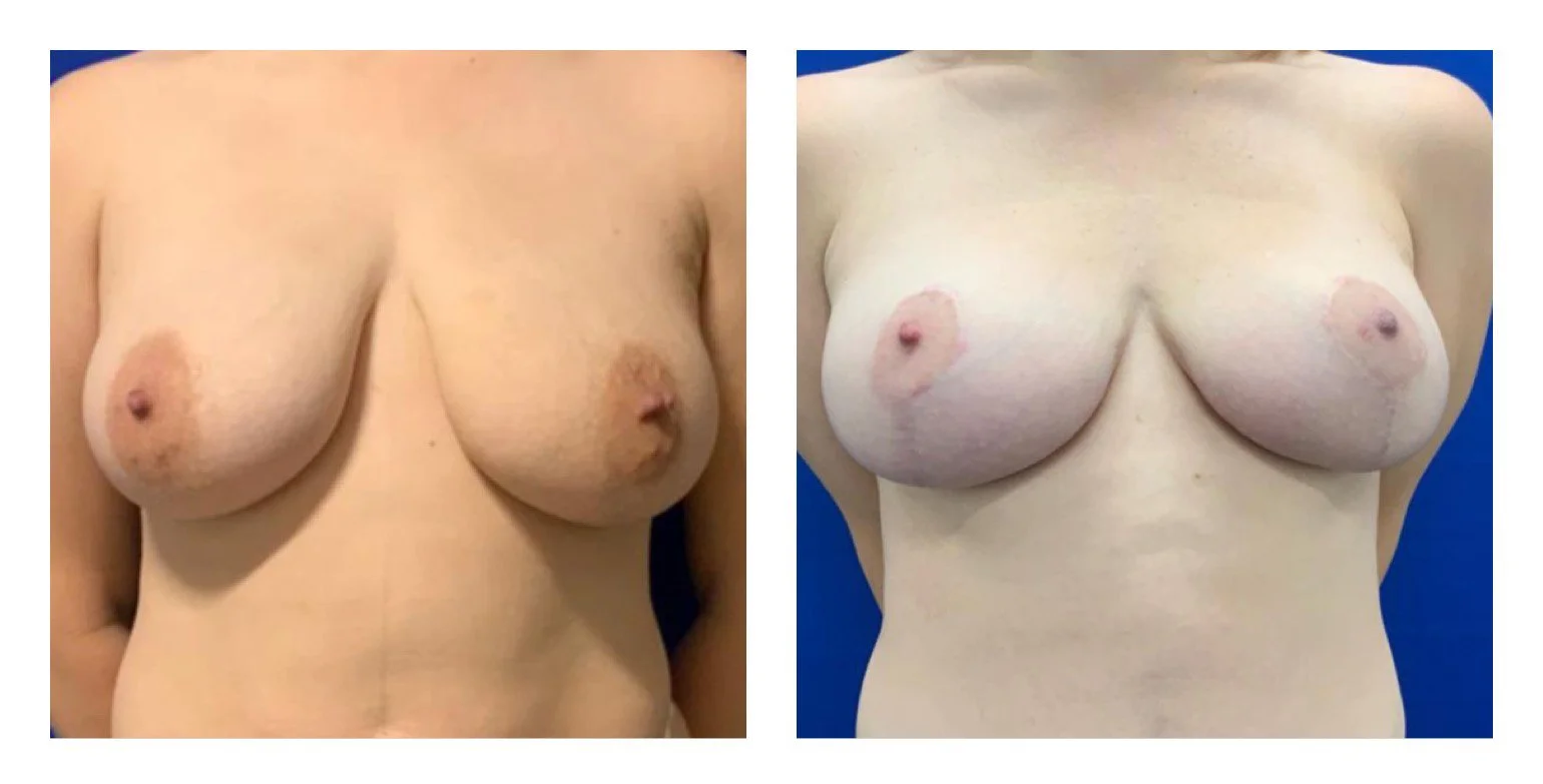 breast lift 5.jpg