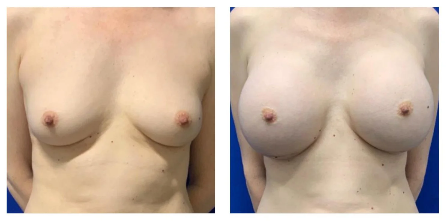 Comparison of a woman's bare breasts before and after breast augmentation surgery, showing increased size and fuller appearance.