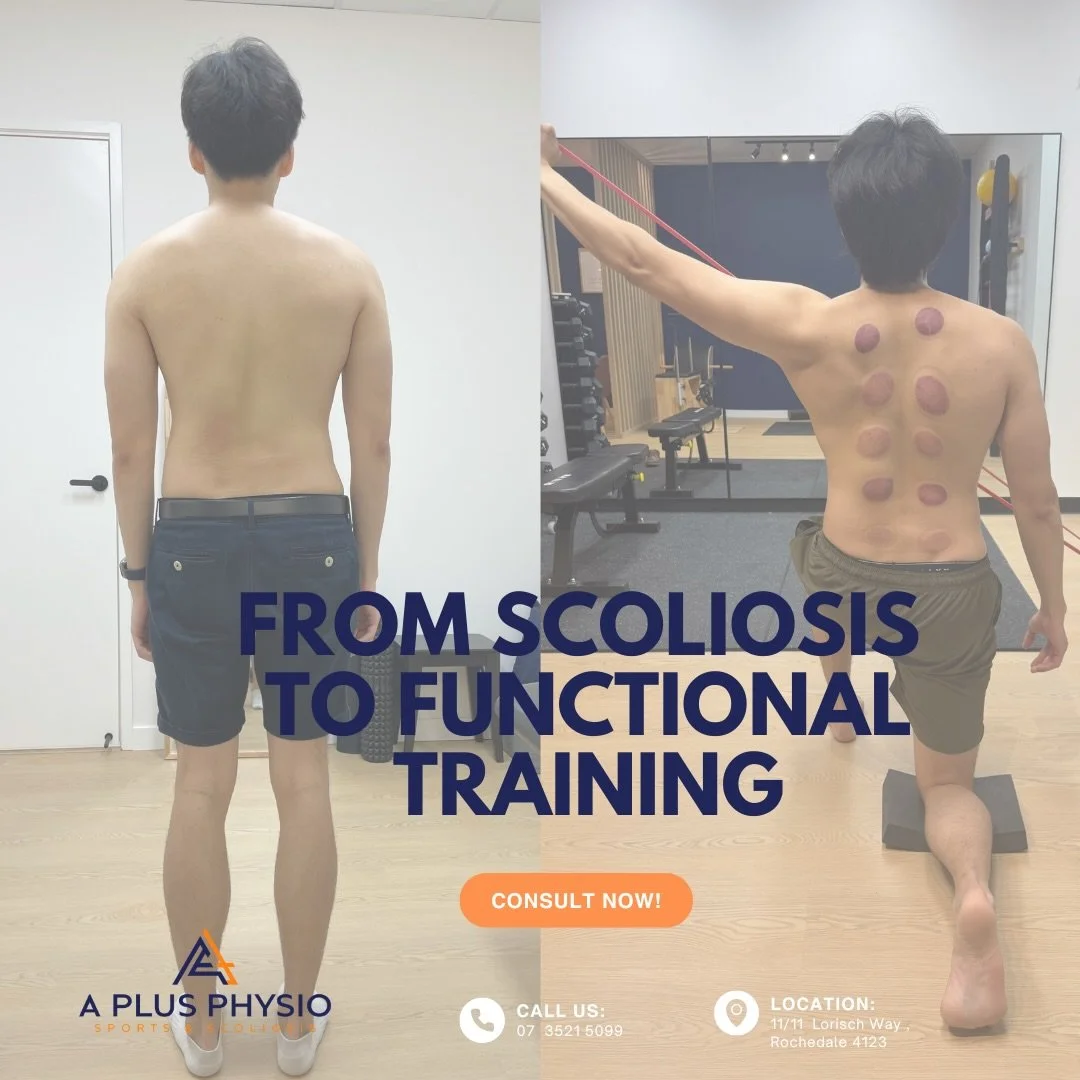 You are more than an X-ray. 🦴✨
Scoliosis treatment isn&rsquo;t &ldquo;one size fits all.&rdquo; It evolves as you do. Whether we are preventing progression in teens or enhancing performance in adults, our philosophy at A Plus Physio is simple:

We t