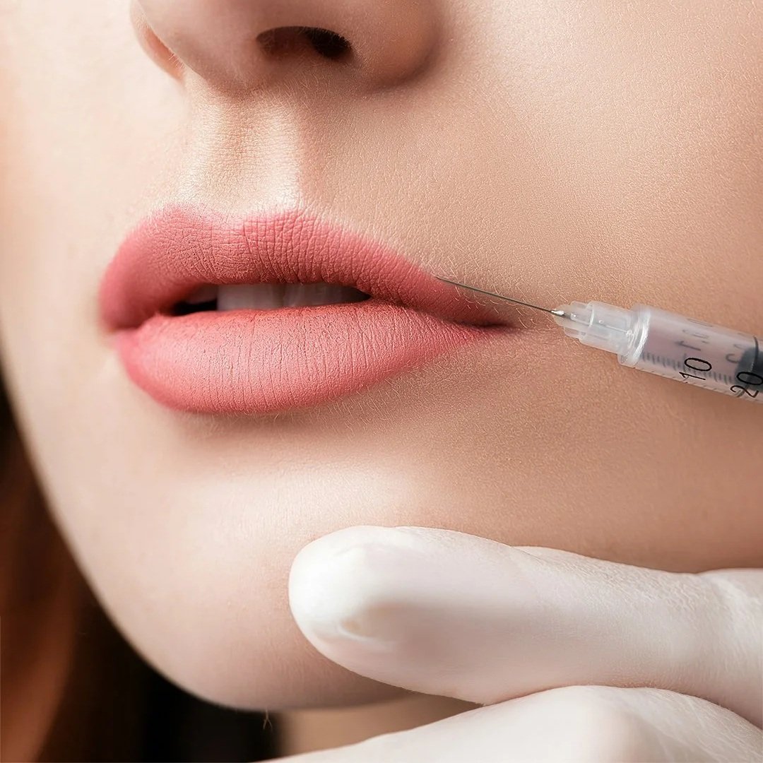 Beautiful, natural-looking lip enhancement achieved with lip filler and lip flip treatments. These popular non-surgical cosmetic procedures can increase lip volume, improve lip definition, enhance cupid's bow shape, and create a fuller, more youthful