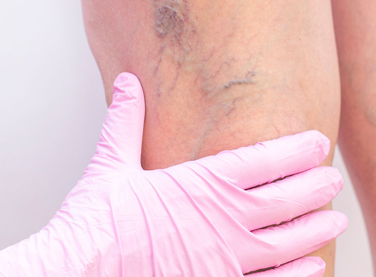 spider vein removal.png