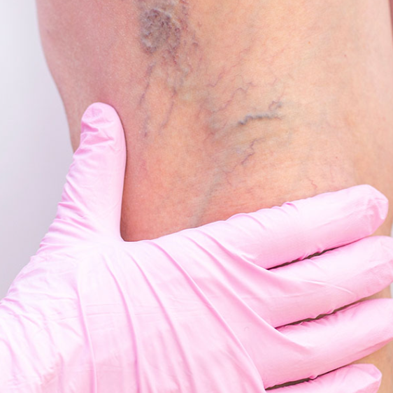 A patient receiving spider vein treatment to diminish the appearance of unwanted veins and improve overall skin aesthetics. Spider vein removal is a popular non-surgical procedure that can help reduce visible red, blue, and purple veins on the legs.