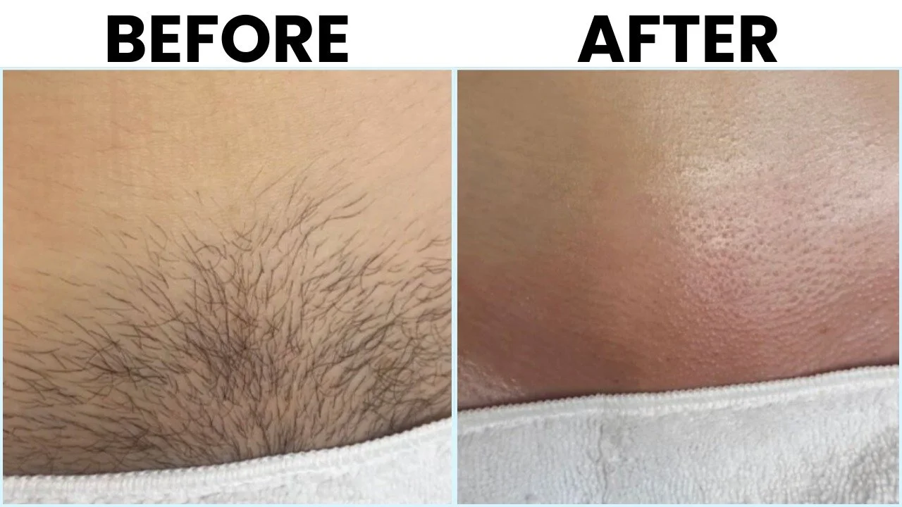 Laser Hair Removal Before and After 8.jpeg