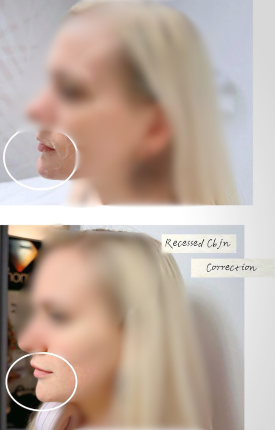 Chin filler before and after