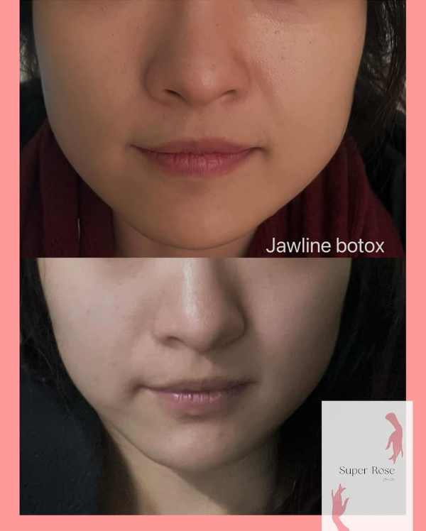 Botox before and after