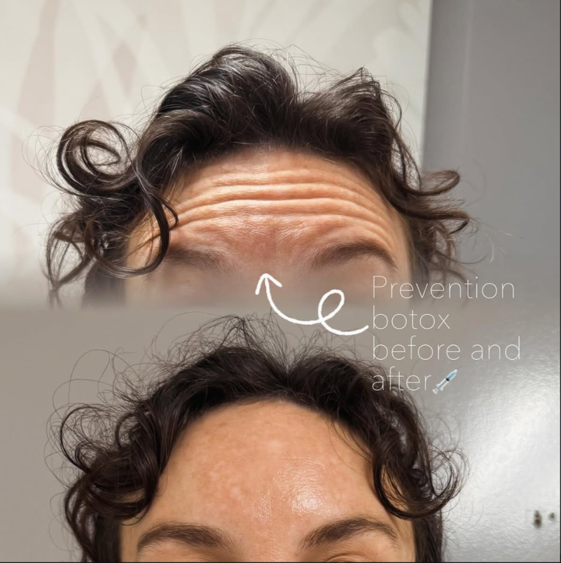 Botox before and after