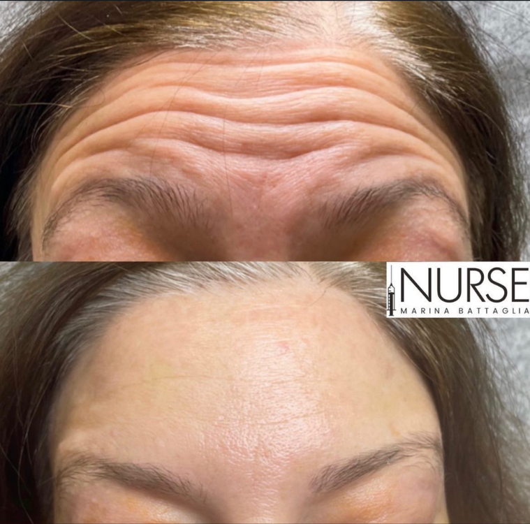 Botox before and after