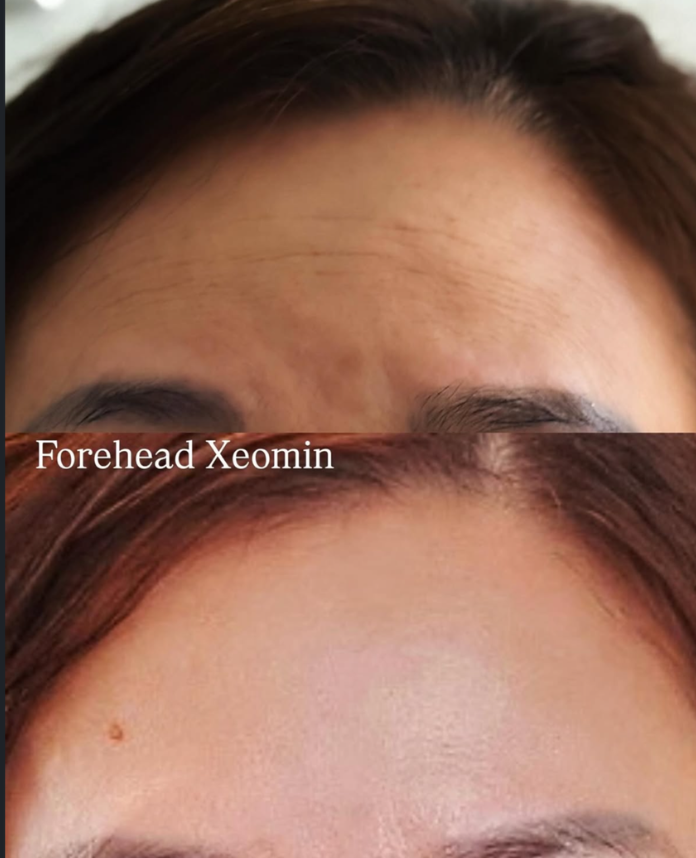 Botox before and after