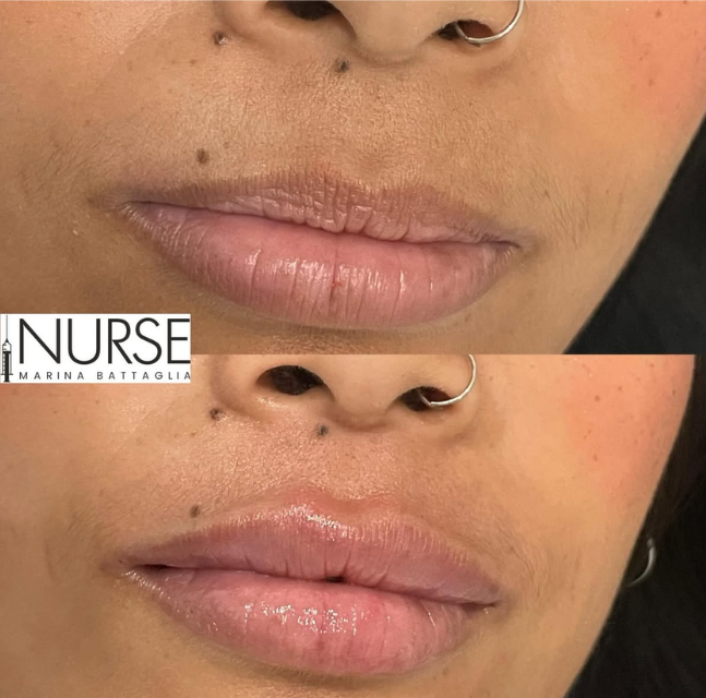 Lip filler before and after