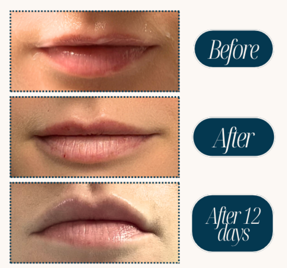 Lip filler before and after
