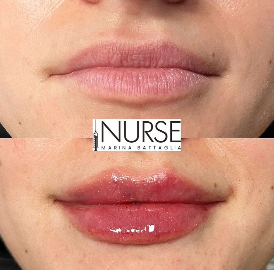 Lip filler before and after