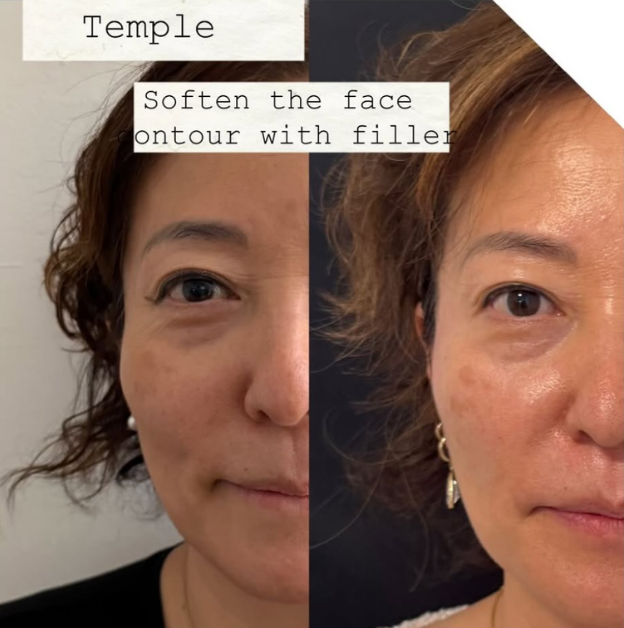 Facial filler before and after