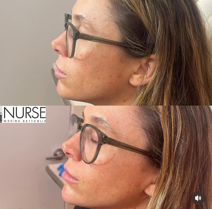 Chin filler before and after