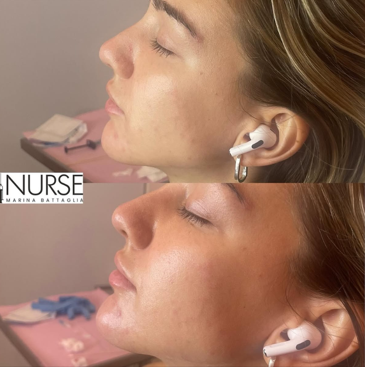 Chin filler before and after