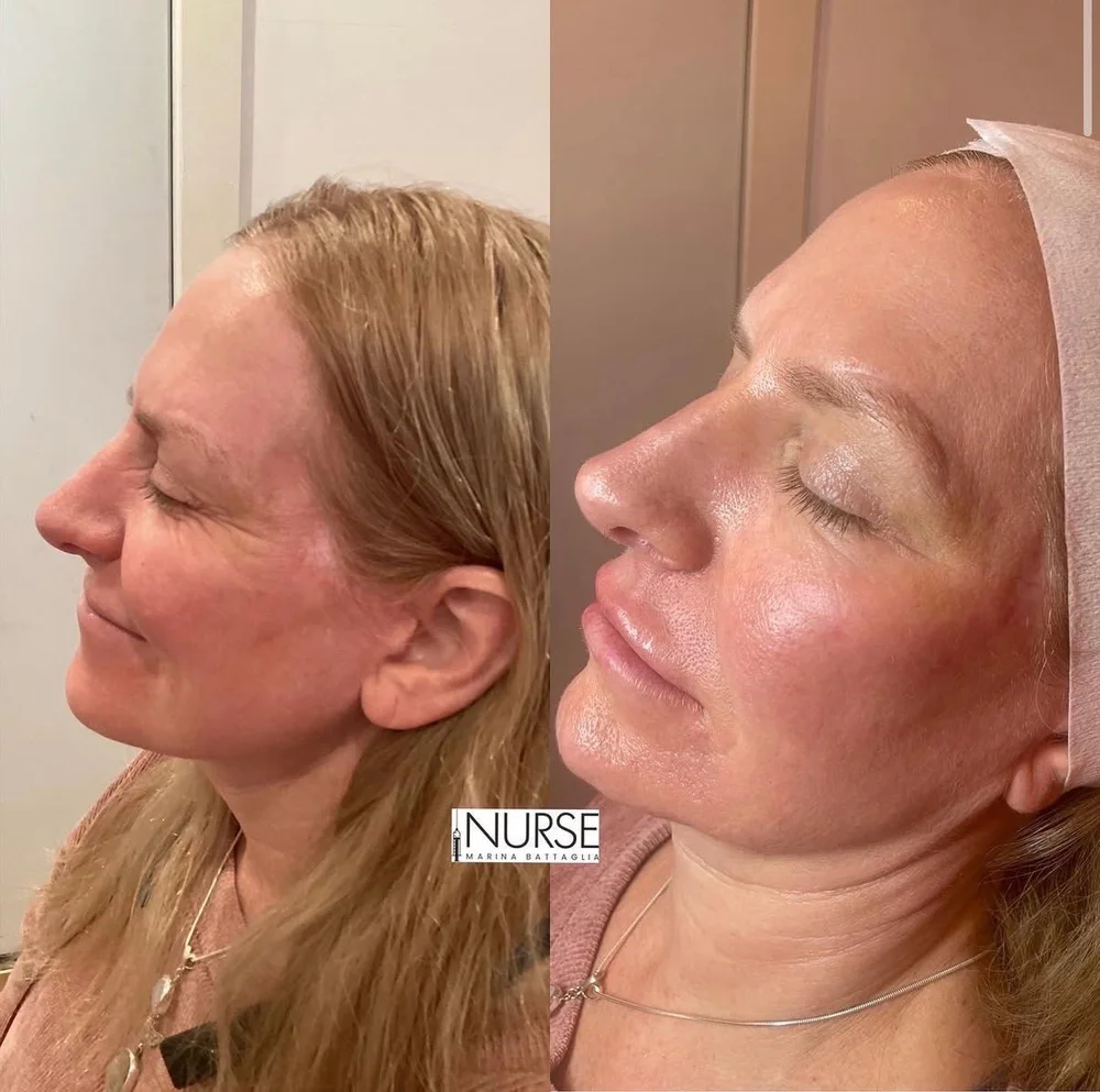 Facial filler before and after