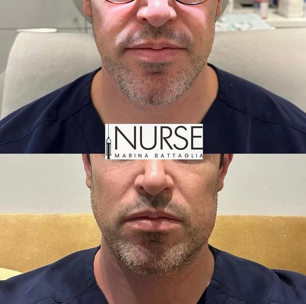 Facial filler before and after