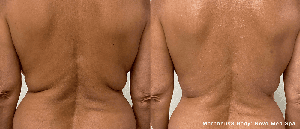 Morpheus8 skin tightening before and after