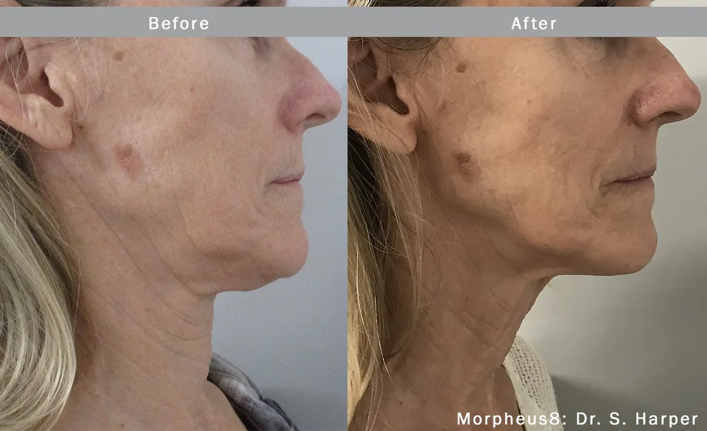 Morpheus8 skin tightening before and after