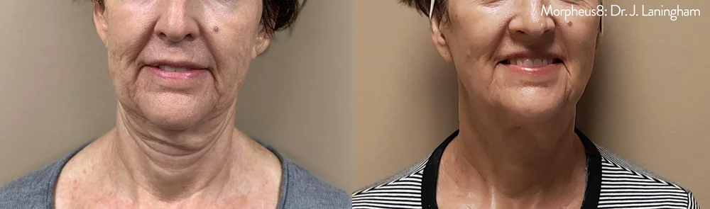 Morpheus8 skin tightening before and after