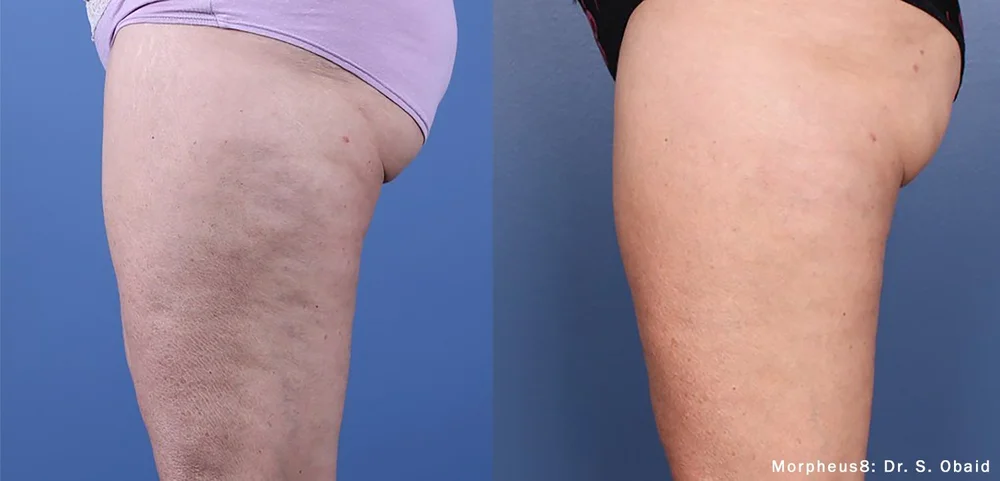 Morpheus8 skin tightening before and after