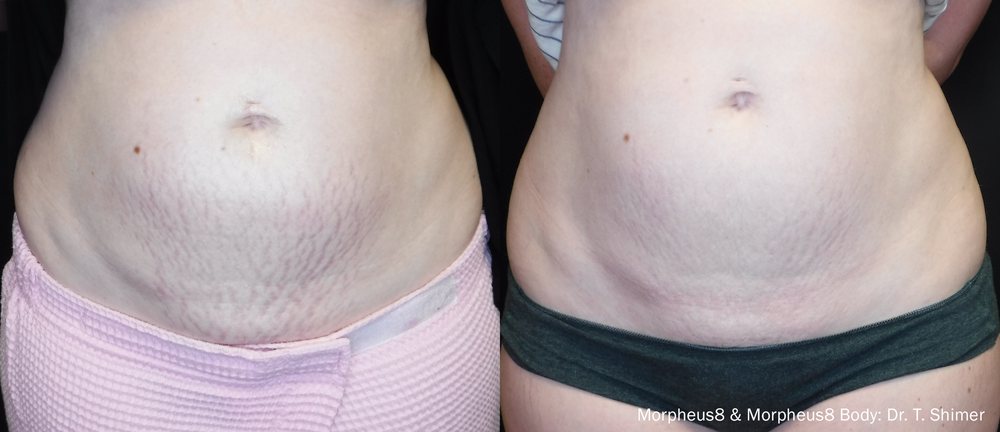 Morpheus8 skin tightening before and after
