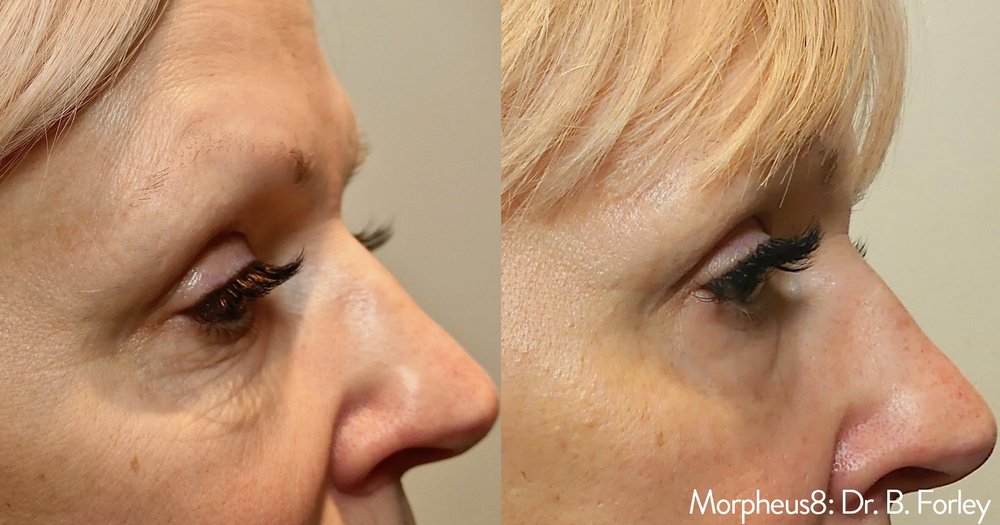Morpheus8 skin tightening before and after