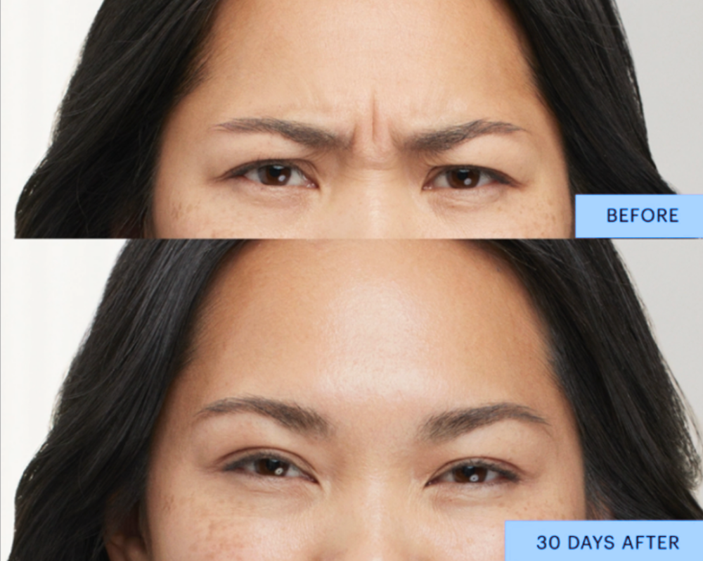 Botox before and after