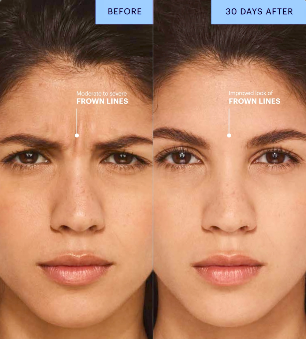 Botox before and after