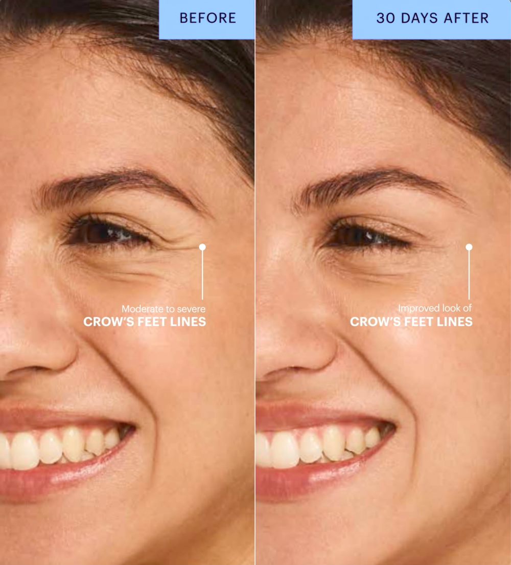 Botox before and after